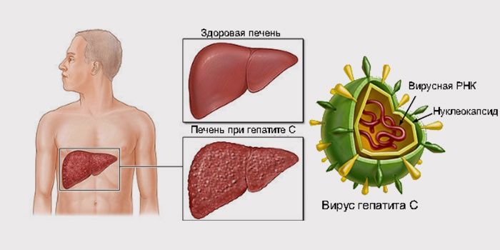 ВИРУСНЫЙ ГЕПАТИТ С